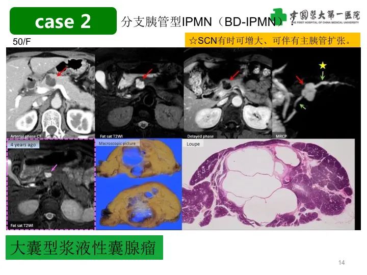 影像PPT - 【PPT】胰腺囊性病变影像学诊断要点与误区-14
