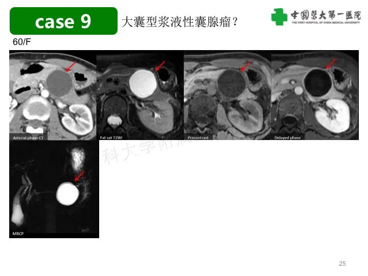 影像PPT - 【PPT】胰腺囊性病变影像学诊断要点与误区-25