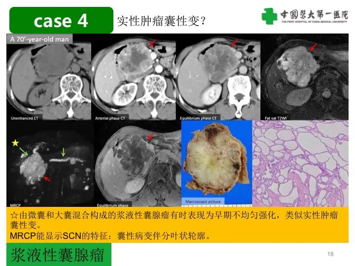 影像PPT - 【PPT】胰腺囊性病变影像学诊断要点与误区-18