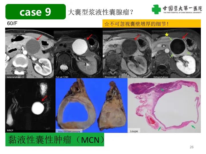 影像PPT - 【PPT】胰腺囊性病变影像学诊断要点与误区-26