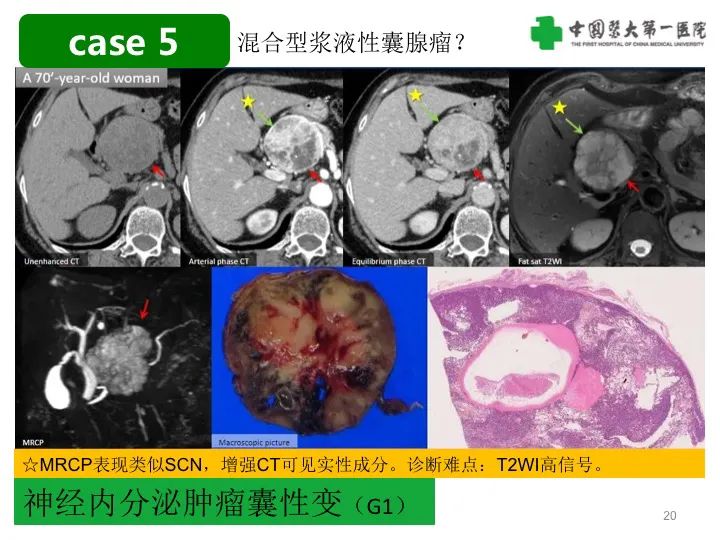 影像PPT - 【PPT】胰腺囊性病变影像学诊断要点与误区-20
