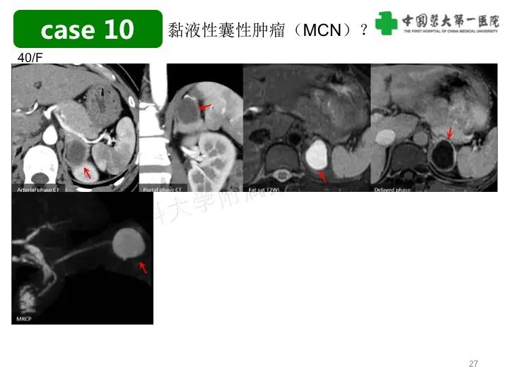 影像PPT - 【PPT】胰腺囊性病变影像学诊断要点与误区-27