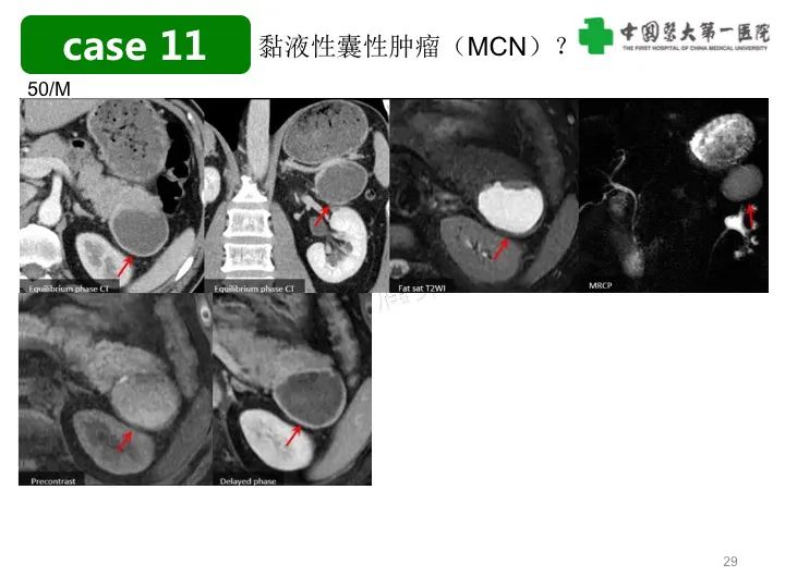 影像PPT - 【PPT】胰腺囊性病变影像学诊断要点与误区-29