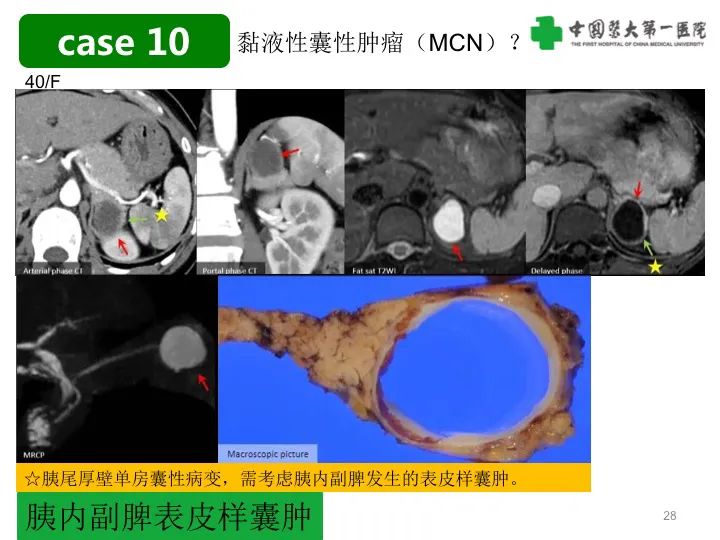 影像PPT - 【PPT】胰腺囊性病变影像学诊断要点与误区-28