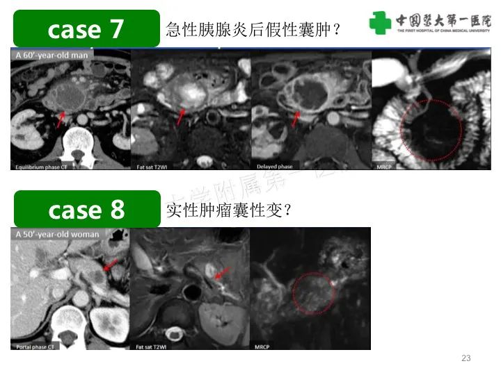 影像PPT - 【PPT】胰腺囊性病变影像学诊断要点与误区-23