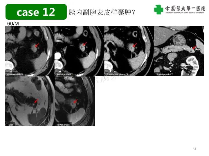 影像PPT - 【PPT】胰腺囊性病变影像学诊断要点与误区-31