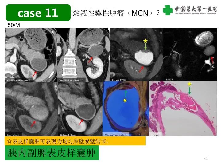 影像PPT - 【PPT】胰腺囊性病变影像学诊断要点与误区-30