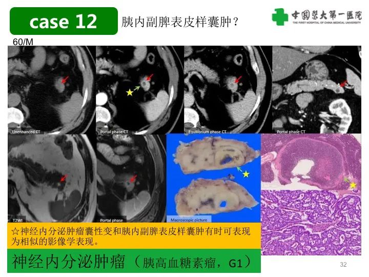 影像PPT - 【PPT】胰腺囊性病变影像学诊断要点与误区-32