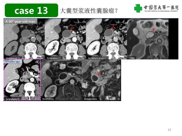 影像PPT - 【PPT】胰腺囊性病变影像学诊断要点与误区-33