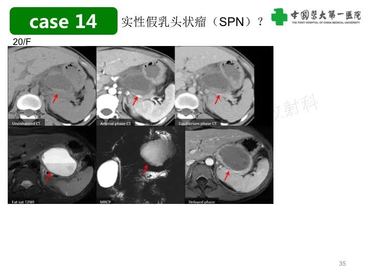 影像PPT - 【PPT】胰腺囊性病变影像学诊断要点与误区-35