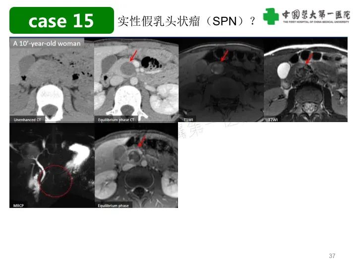 影像PPT - 【PPT】胰腺囊性病变影像学诊断要点与误区-37