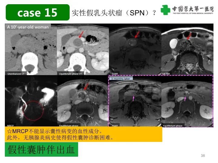 影像PPT - 【PPT】胰腺囊性病变影像学诊断要点与误区-38