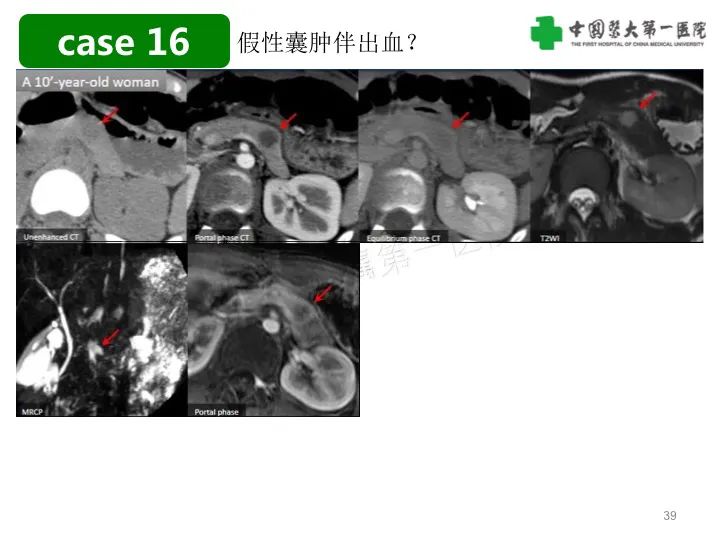 影像PPT - 【PPT】胰腺囊性病变影像学诊断要点与误区-39