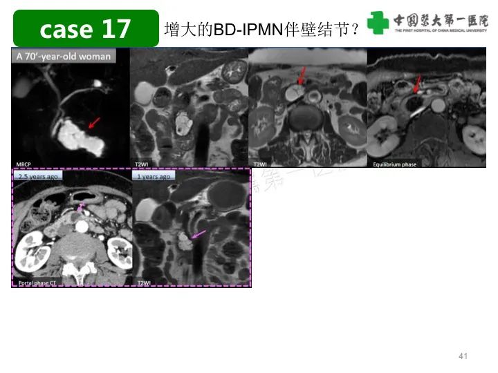影像PPT - 【PPT】胰腺囊性病变影像学诊断要点与误区-41