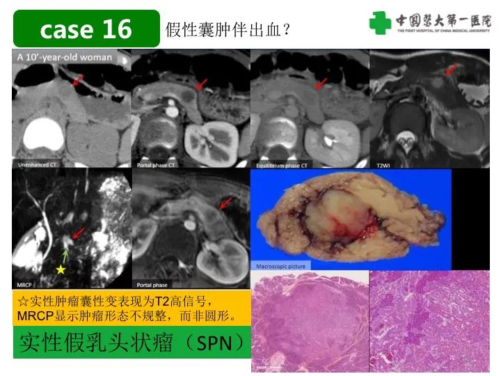 影像PPT - 【PPT】胰腺囊性病变影像学诊断要点与误区-40