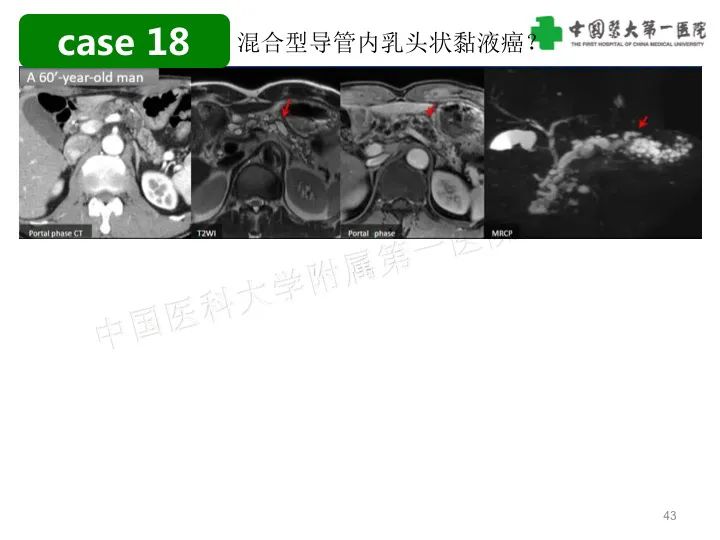 影像PPT - 【PPT】胰腺囊性病变影像学诊断要点与误区-43