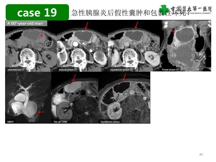 影像PPT - 【PPT】胰腺囊性病变影像学诊断要点与误区-45