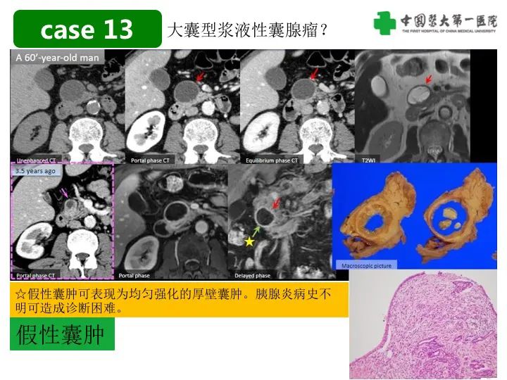 影像PPT - 【PPT】胰腺囊性病变影像学诊断要点与误区-34