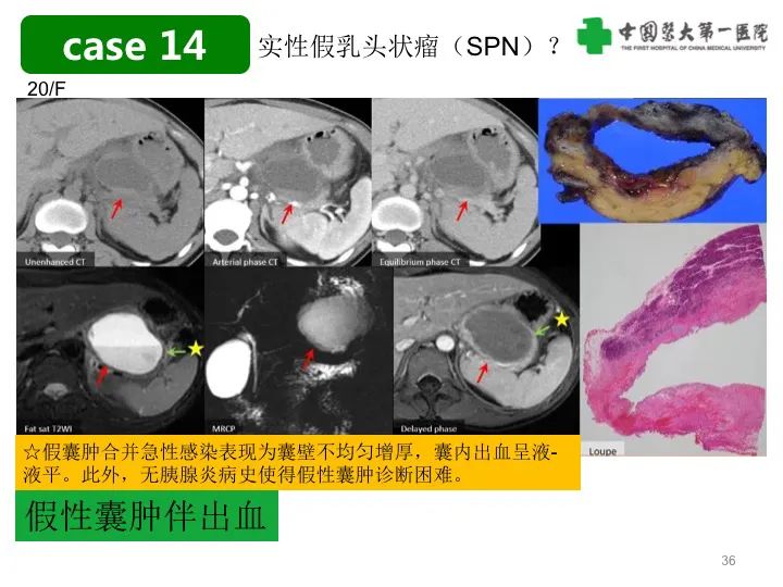 影像PPT - 【PPT】胰腺囊性病变影像学诊断要点与误区-36