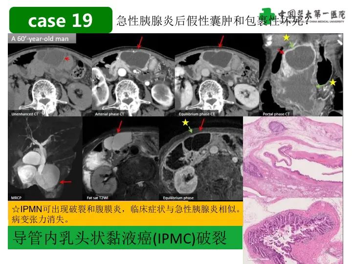 影像PPT - 【PPT】胰腺囊性病变影像学诊断要点与误区-46