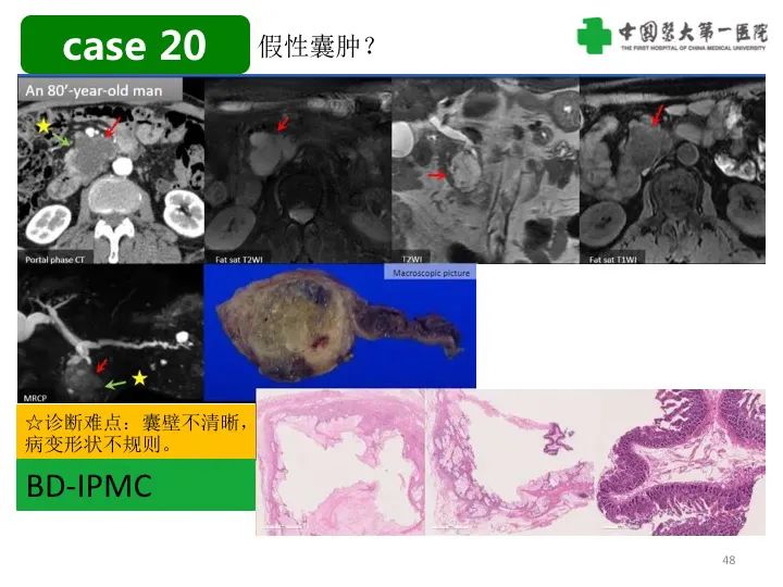 影像PPT - 【PPT】胰腺囊性病变影像学诊断要点与误区-48