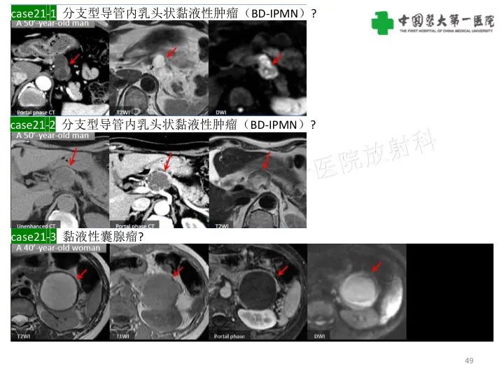 影像PPT - 【PPT】胰腺囊性病变影像学诊断要点与误区-49