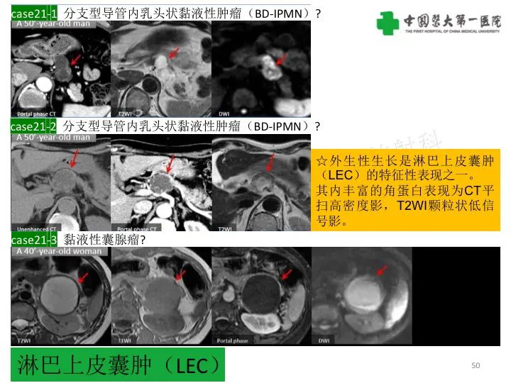 影像PPT - 【PPT】胰腺囊性病变影像学诊断要点与误区-50