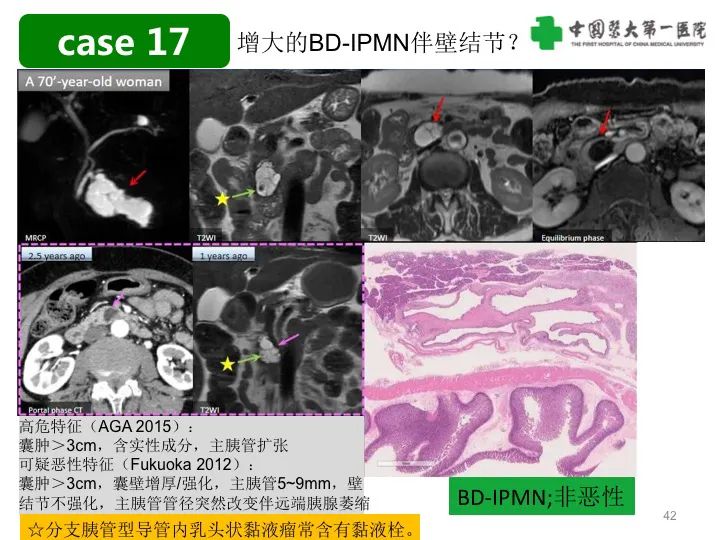 影像PPT - 【PPT】胰腺囊性病变影像学诊断要点与误区-42