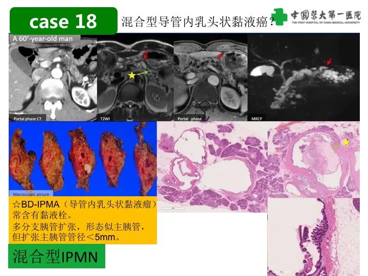 影像PPT - 【PPT】胰腺囊性病变影像学诊断要点与误区-44