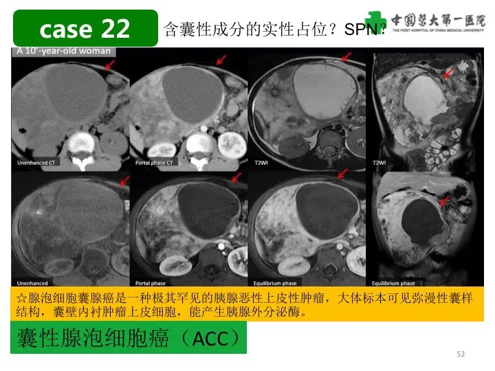 影像PPT - 【PPT】胰腺囊性病变影像学诊断要点与误区-52