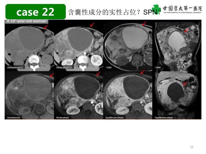 影像PPT - 【PPT】胰腺囊性病变影像学诊断要点与误区-51