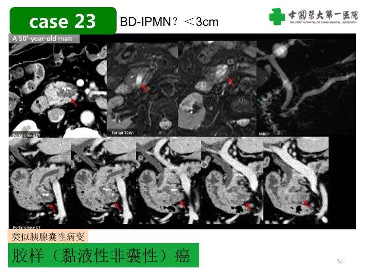 影像PPT - 【PPT】胰腺囊性病变影像学诊断要点与误区-54