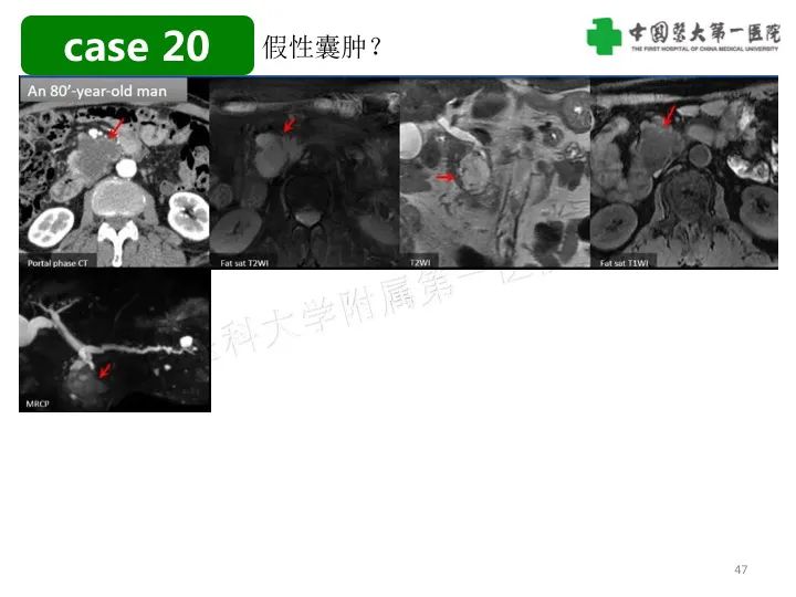 影像PPT - 【PPT】胰腺囊性病变影像学诊断要点与误区-47