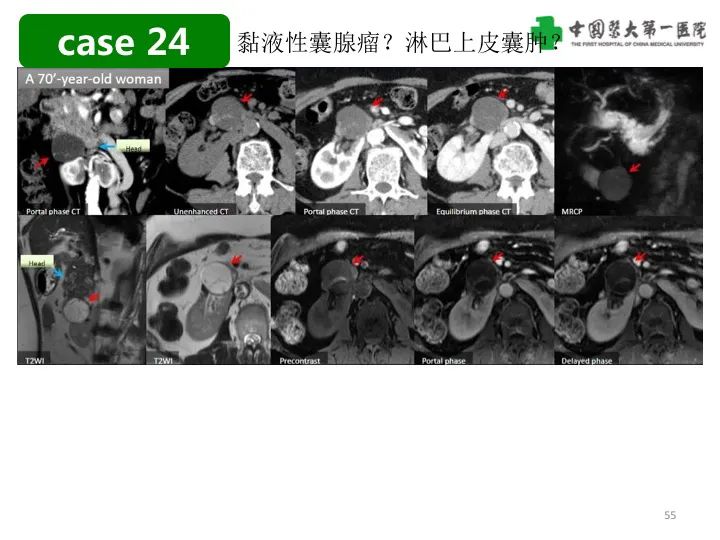影像PPT - 【PPT】胰腺囊性病变影像学诊断要点与误区-55