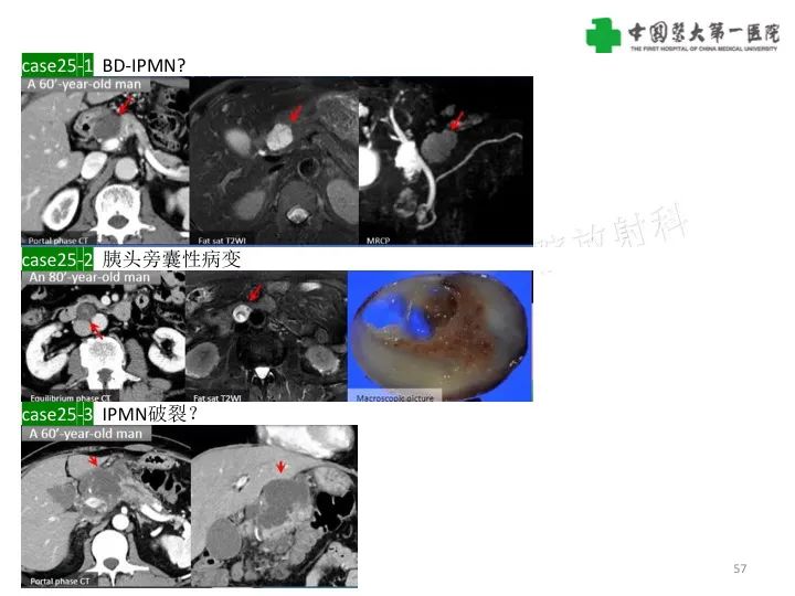 影像PPT - 【PPT】胰腺囊性病变影像学诊断要点与误区-57