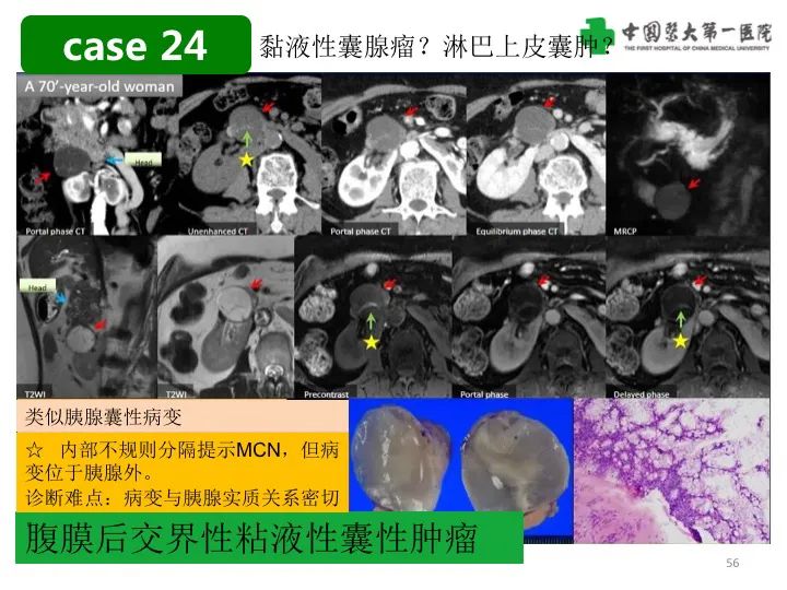 影像PPT - 【PPT】胰腺囊性病变影像学诊断要点与误区-56
