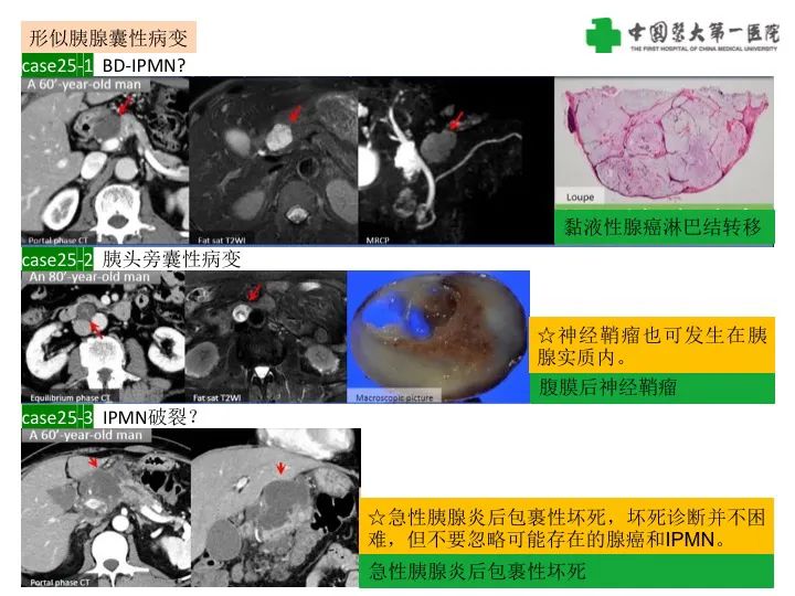影像PPT - 【PPT】胰腺囊性病变影像学诊断要点与误区-58