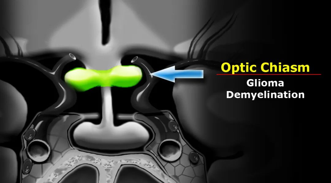 影像PPT - 鞍区病变的MRI分析思路-4 影像PPT - 鞍区病变的MRI分析思路-4