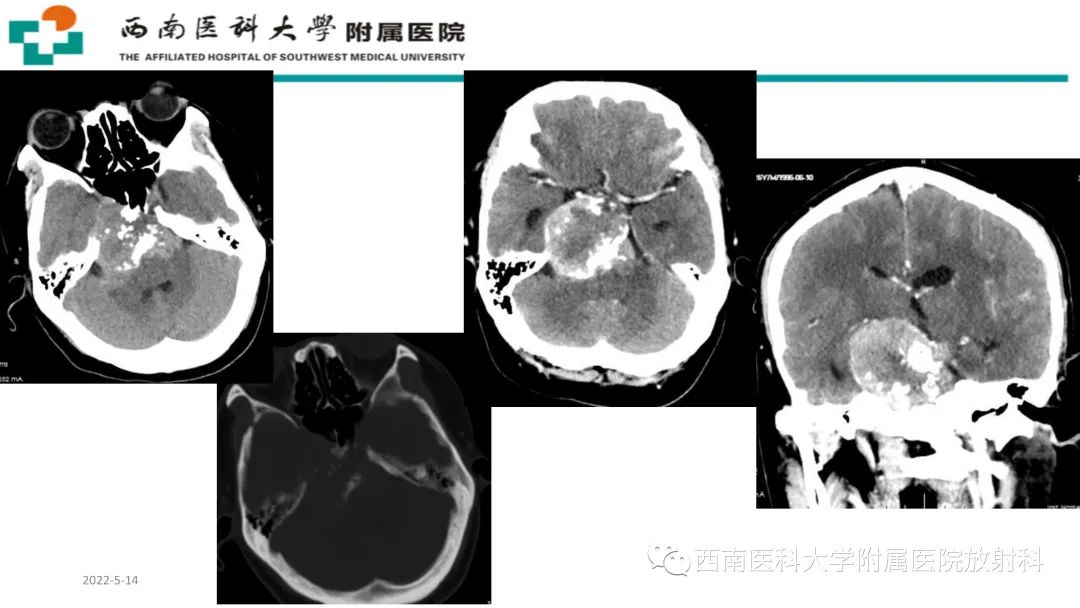影像PPT - 【PPT】颅底脊索瘤-3