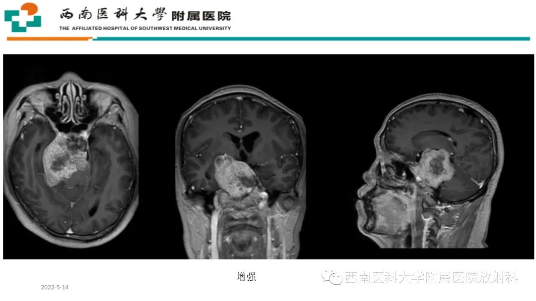 影像PPT - 【PPT】颅底脊索瘤-5