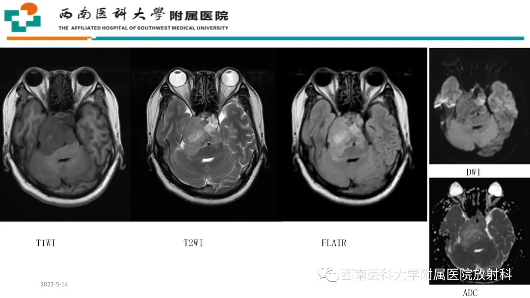 影像PPT - 【PPT】颅底脊索瘤-4