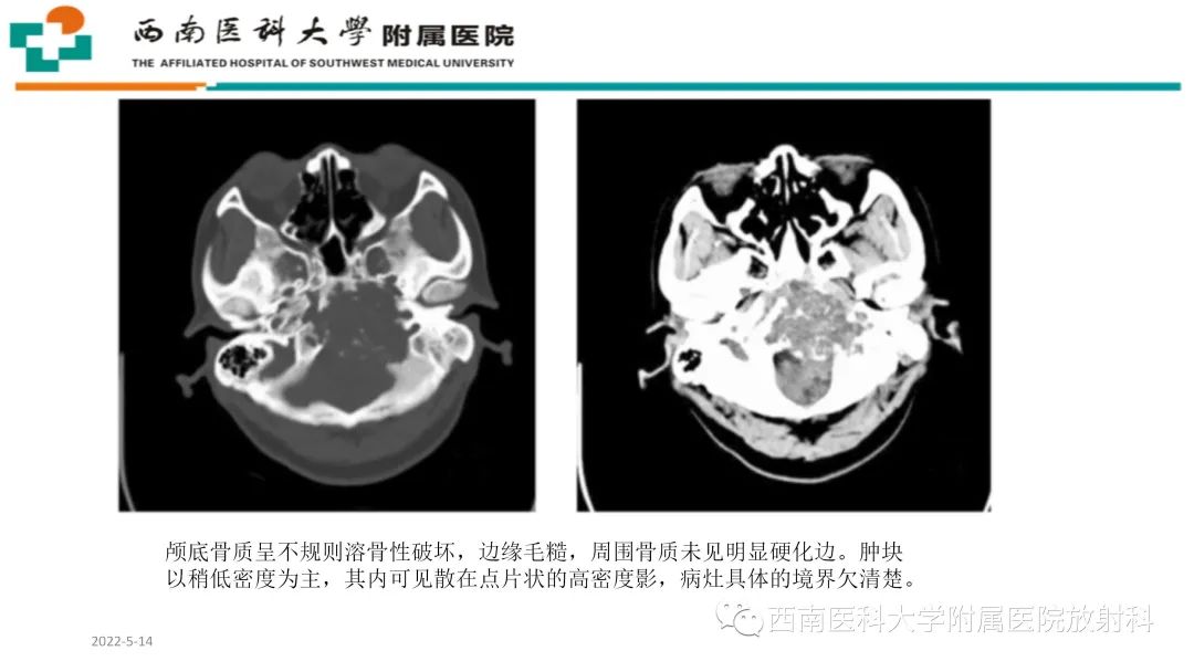 影像PPT - 【PPT】颅底脊索瘤-17