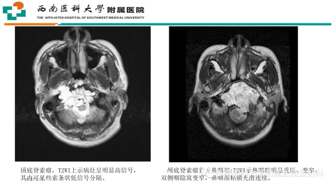 影像PPT - 【PPT】颅底脊索瘤-18