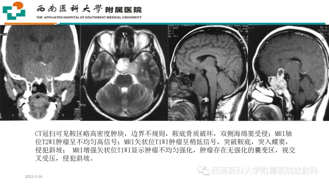 影像PPT - 【PPT】颅底脊索瘤-25