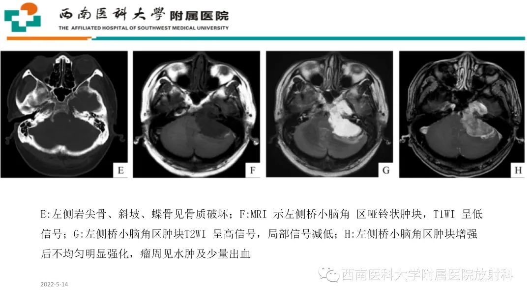 影像PPT - 【PPT】颅底脊索瘤-23