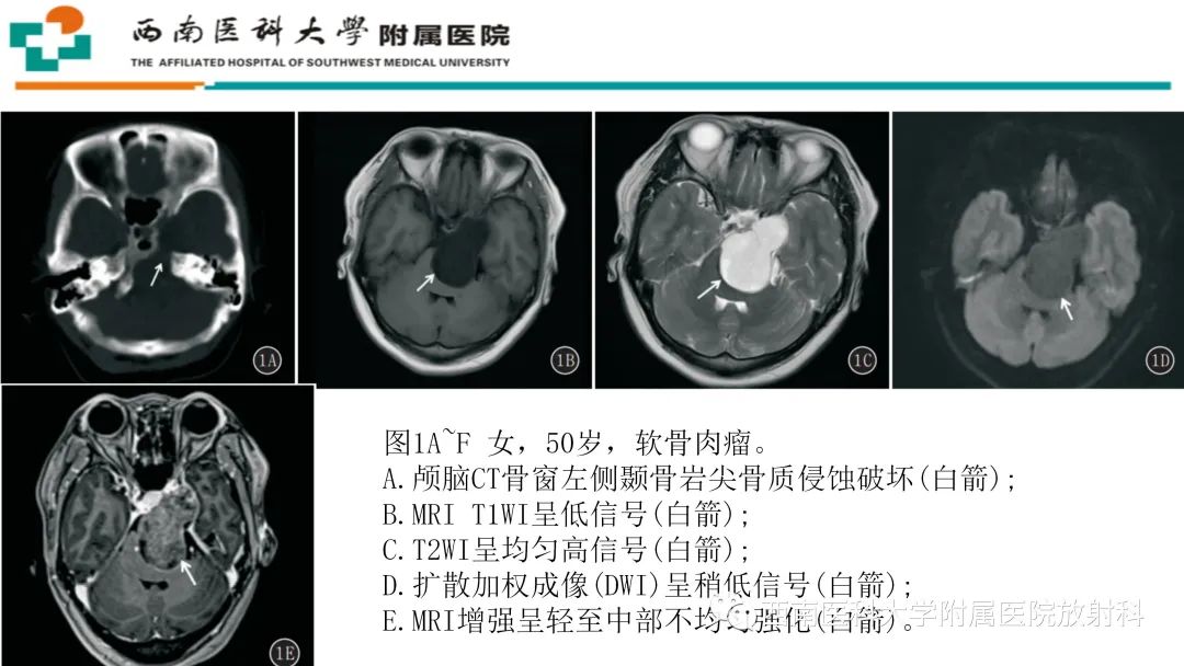 影像PPT - 【PPT】颅底脊索瘤-20