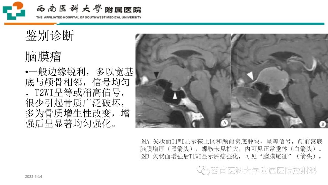 影像PPT - 【PPT】颅底脊索瘤-26