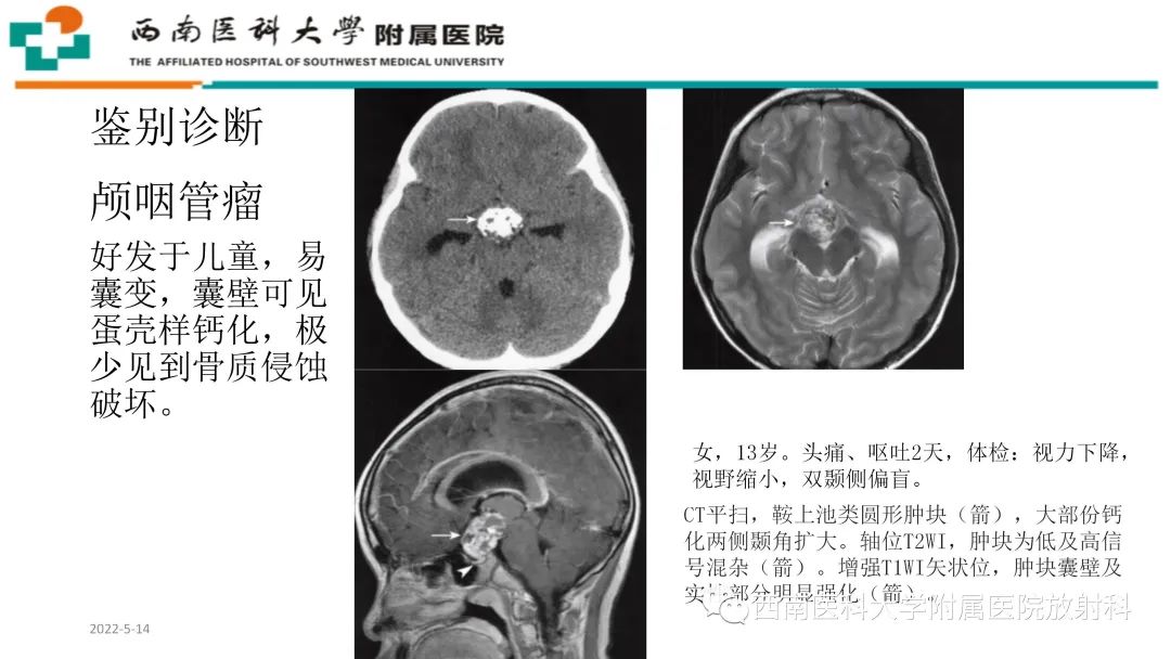 影像PPT - 【PPT】颅底脊索瘤-27