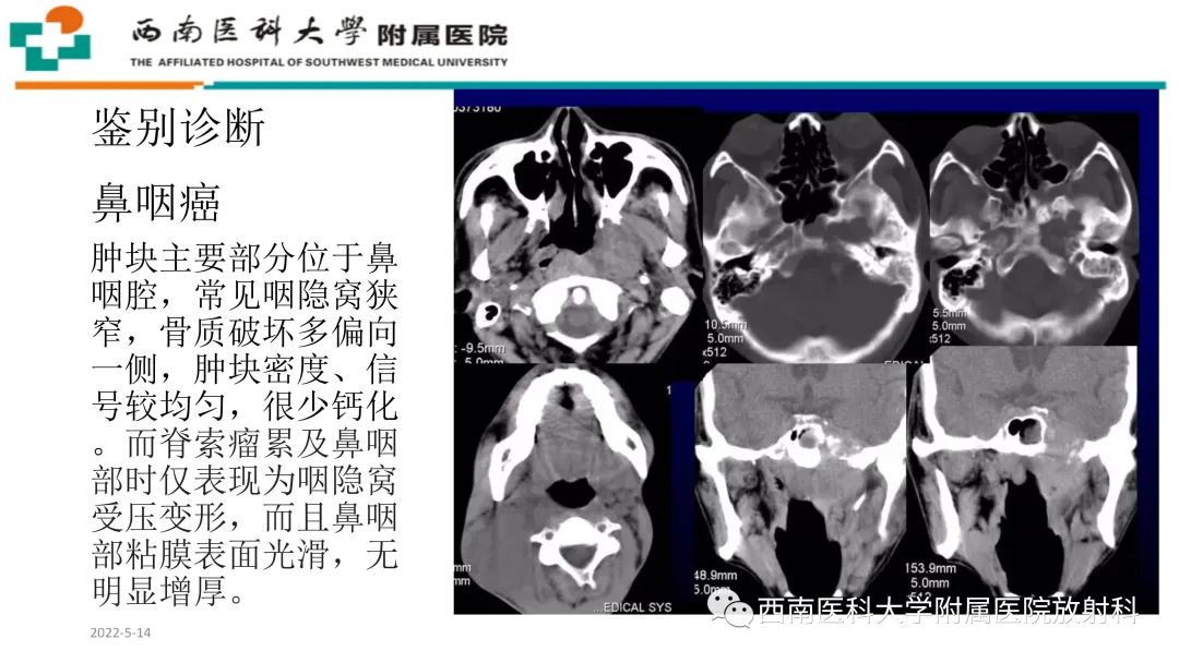 影像PPT - 【PPT】颅底脊索瘤-28