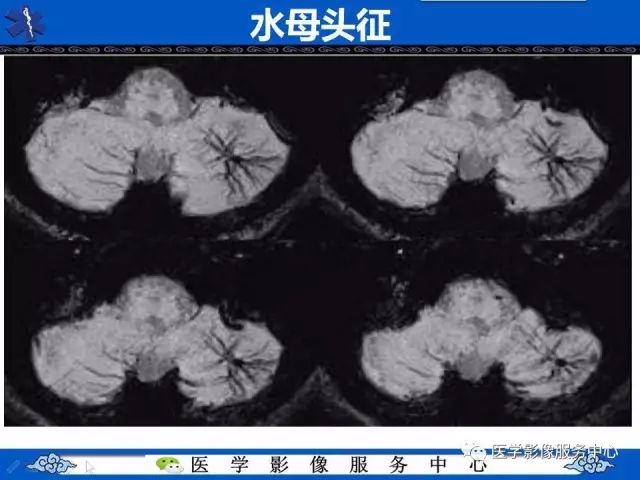 影像PPT - 水母头征-4
